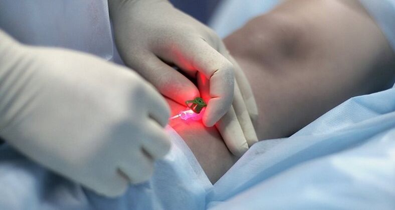 Хируршко лечење проширених вена